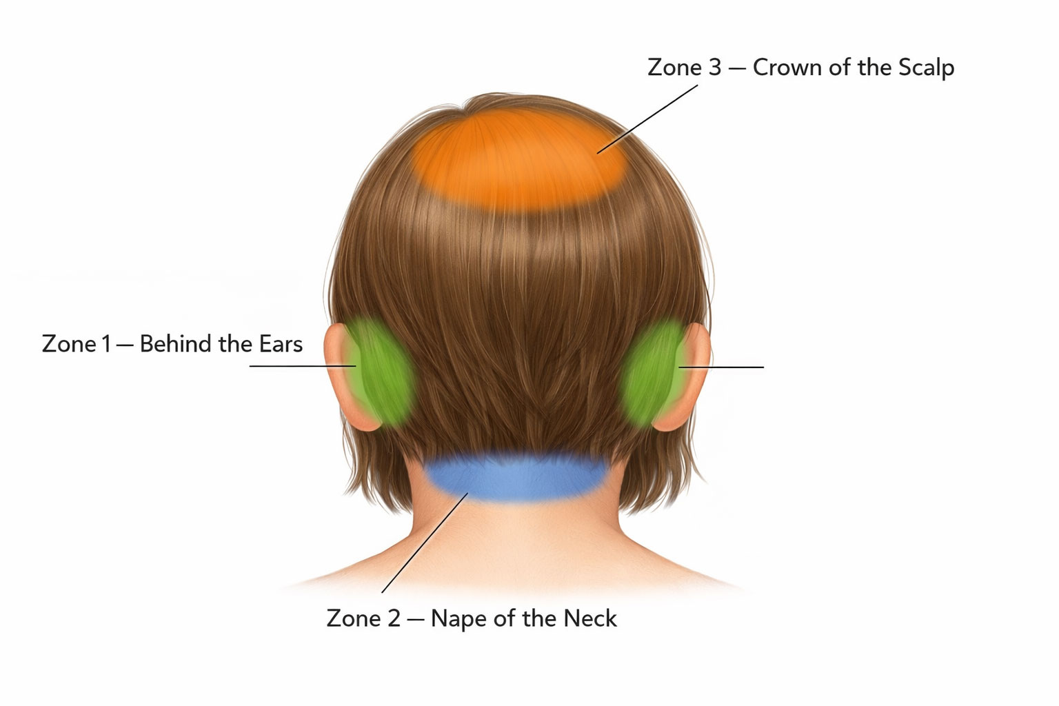 Diagram of a child's head showing the three zones where head lice concentrate: Zone 1 behind the ears, Zone 2 at the nape of the neck, and Zone 3 at the crown of the scalp
